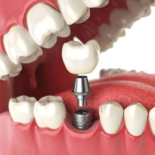 Протезування